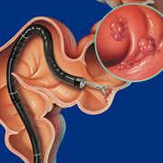 Colonoscopy Procedure