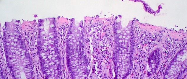 Plastic Optics Colonoscopy