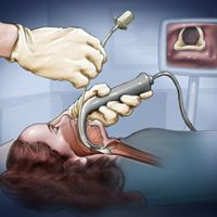 Laryngoscope